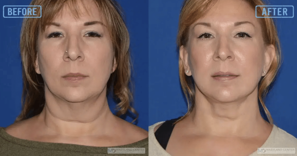 Surgical facelift performed by Dr. Hahn in Balitmore, MD.